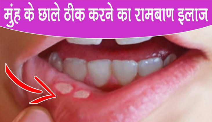  Mouth Ulcers Cure: मुँह के छालों से हैं परेशान तो इन घरेलू नुस्खों से छाले हो जायेंगे छूमंतर 